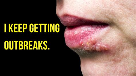 herpes get back to work its hermes commerci|back to back herpes outbreak.